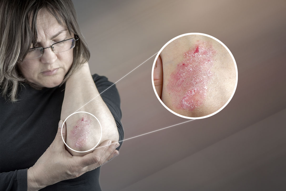 Does-Salt-Therapy-Help-With-Psoriasis-Salt-Scene